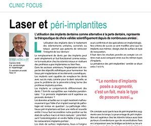 laser-et-peri-implantites-1