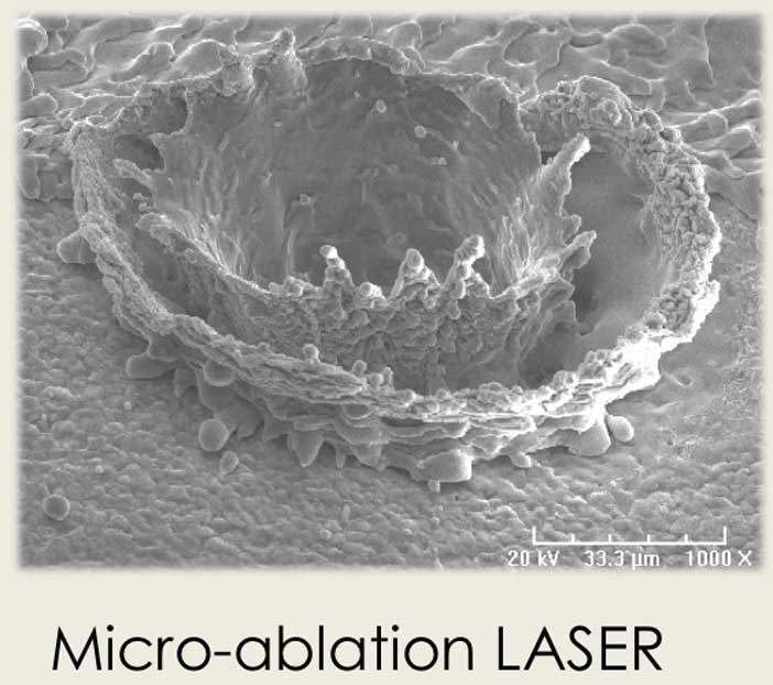 Micro-ablation micrométrique en fonction de la charge hydrique du tissu ciblé
