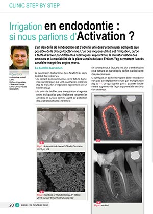 irrigation-en-endodontie-si-nous-parlions-dactivation-1